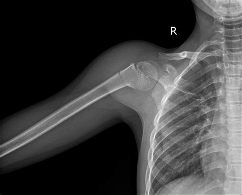 proximal humerus fracture diagnosis